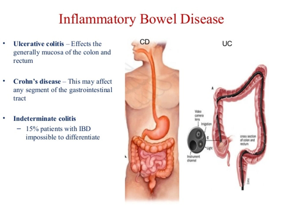 The Role of Acotiamide in the Management of Inflammatory Bowel Disease