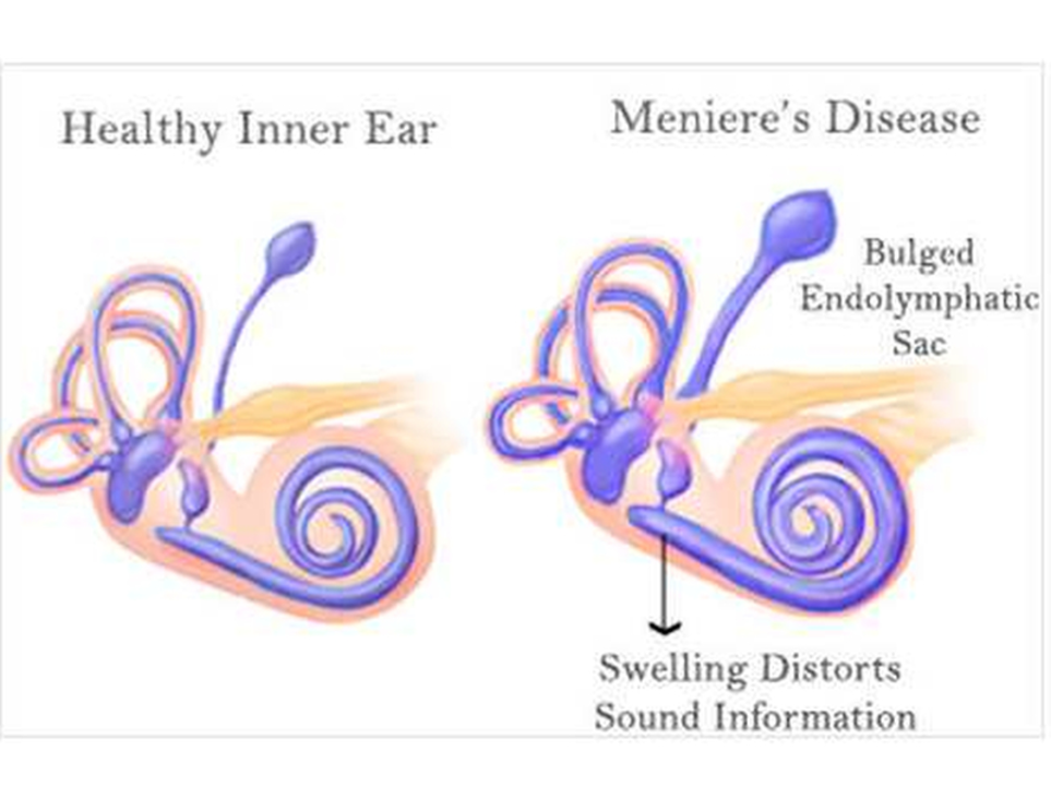 Meniere's Disease and Music Therapy: Healing Through Sound